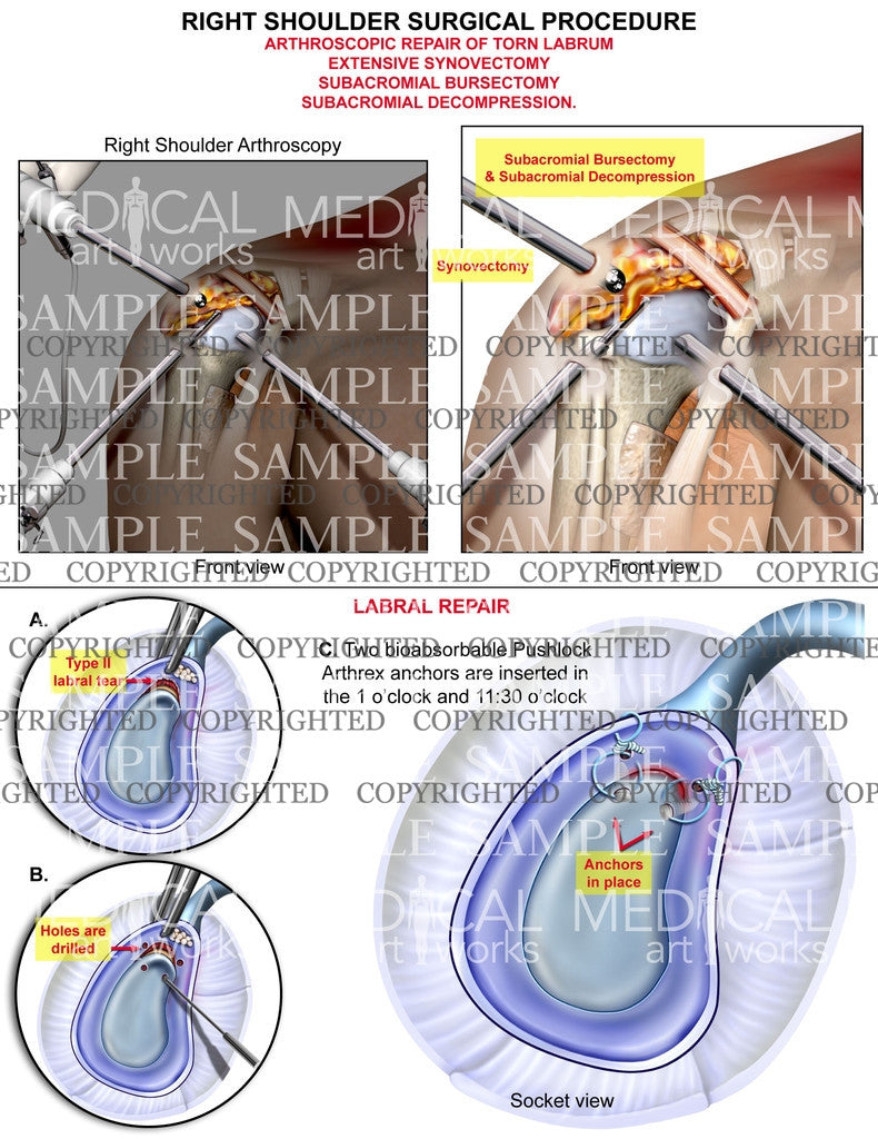 Right Shoulder Arthroscopic procedure