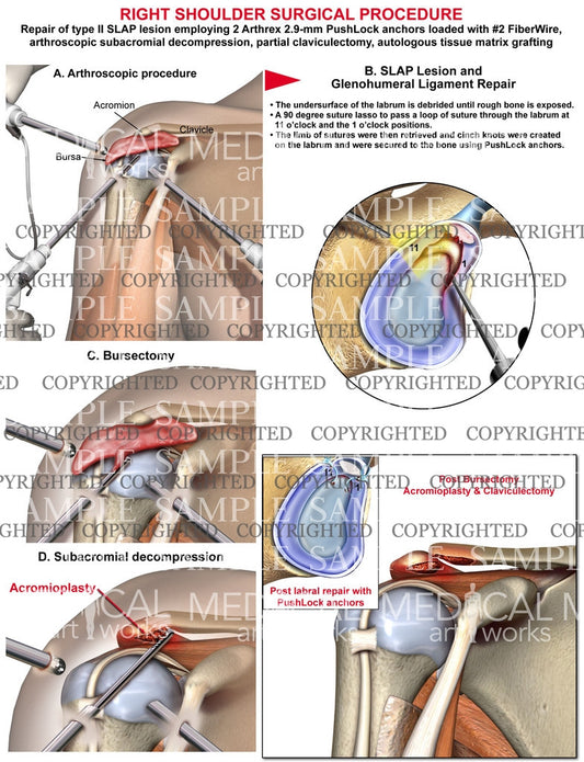 Right Shoulder Arthroscopic Surgical procedure