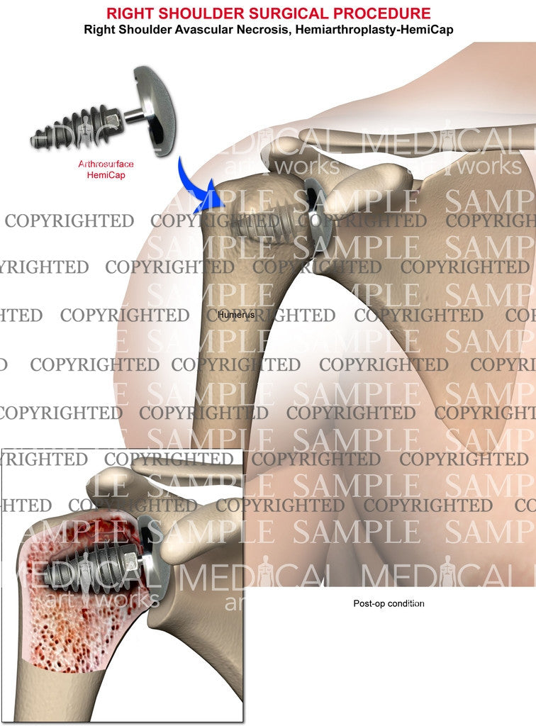 Right Shoulder Hemiarthroplasty (HemiCap)