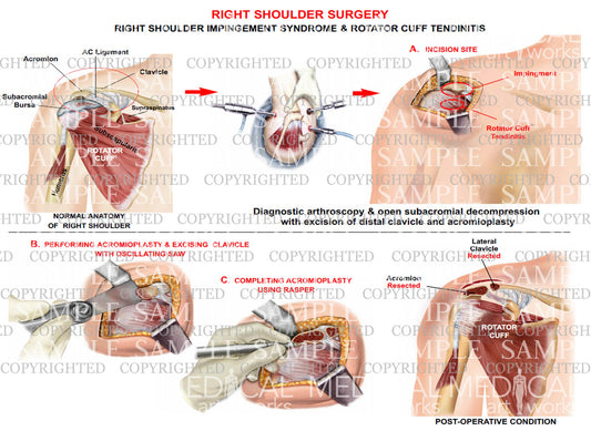 Right shoulder impingement syndrome - Arthroscopic repair