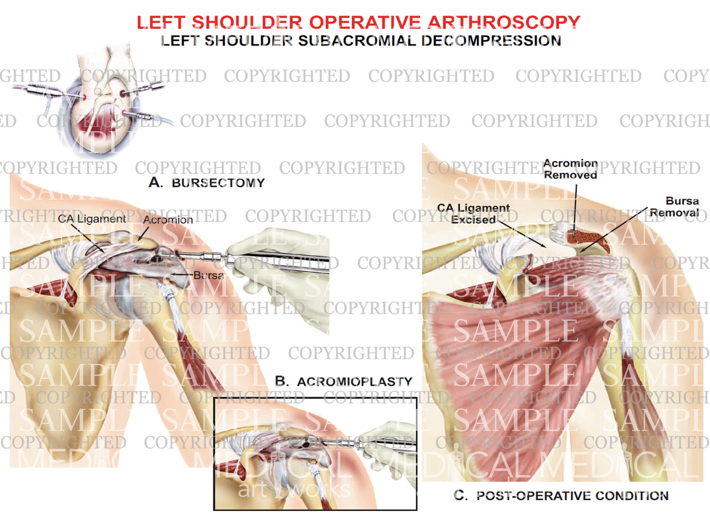 Left shoulder arthroscopic repair - Subacromial decompression