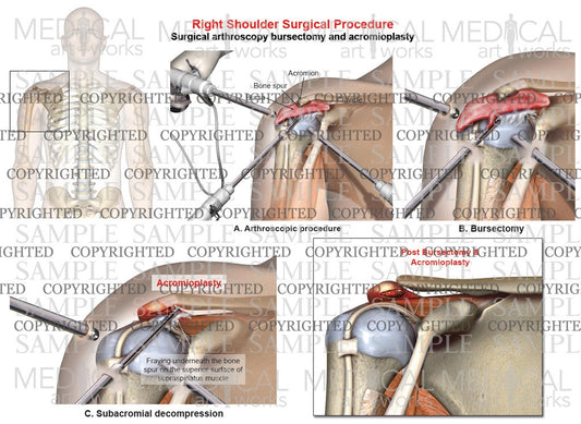 Right arthroscopic surgery bursectomy and acromioplasty