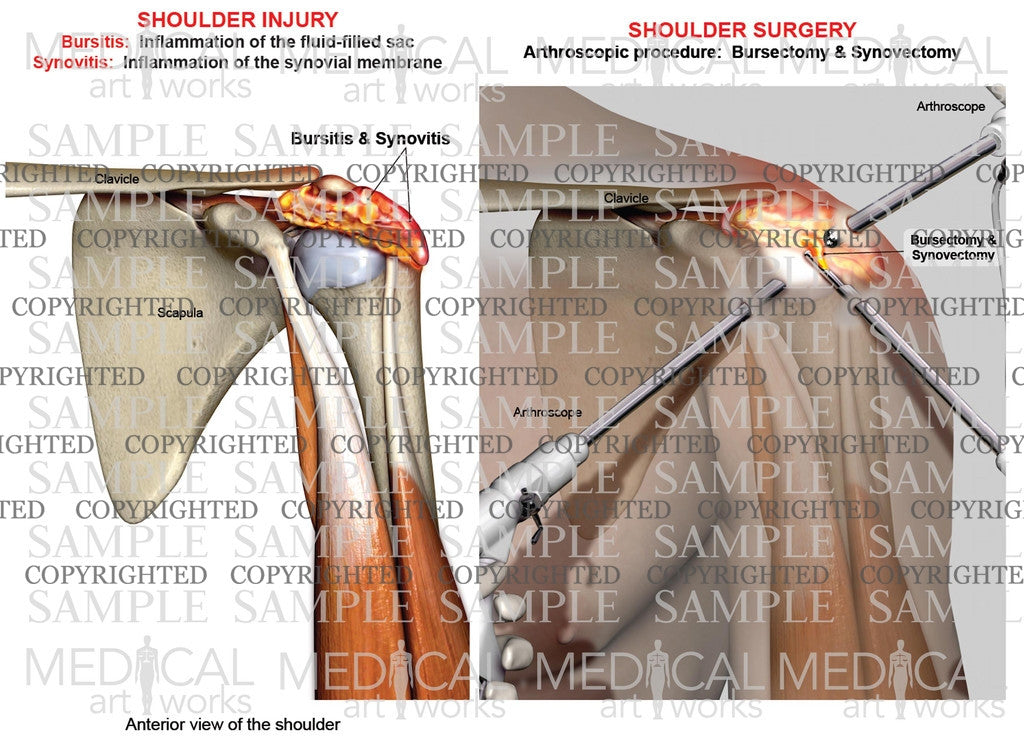 Arthroscopic surgery of bursitis and synovitis