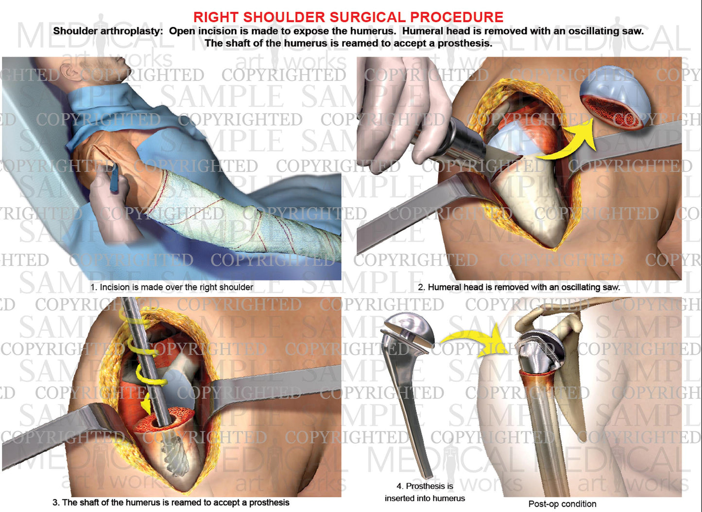 Right shoulder - Arthroplasty - Shoulder replacement