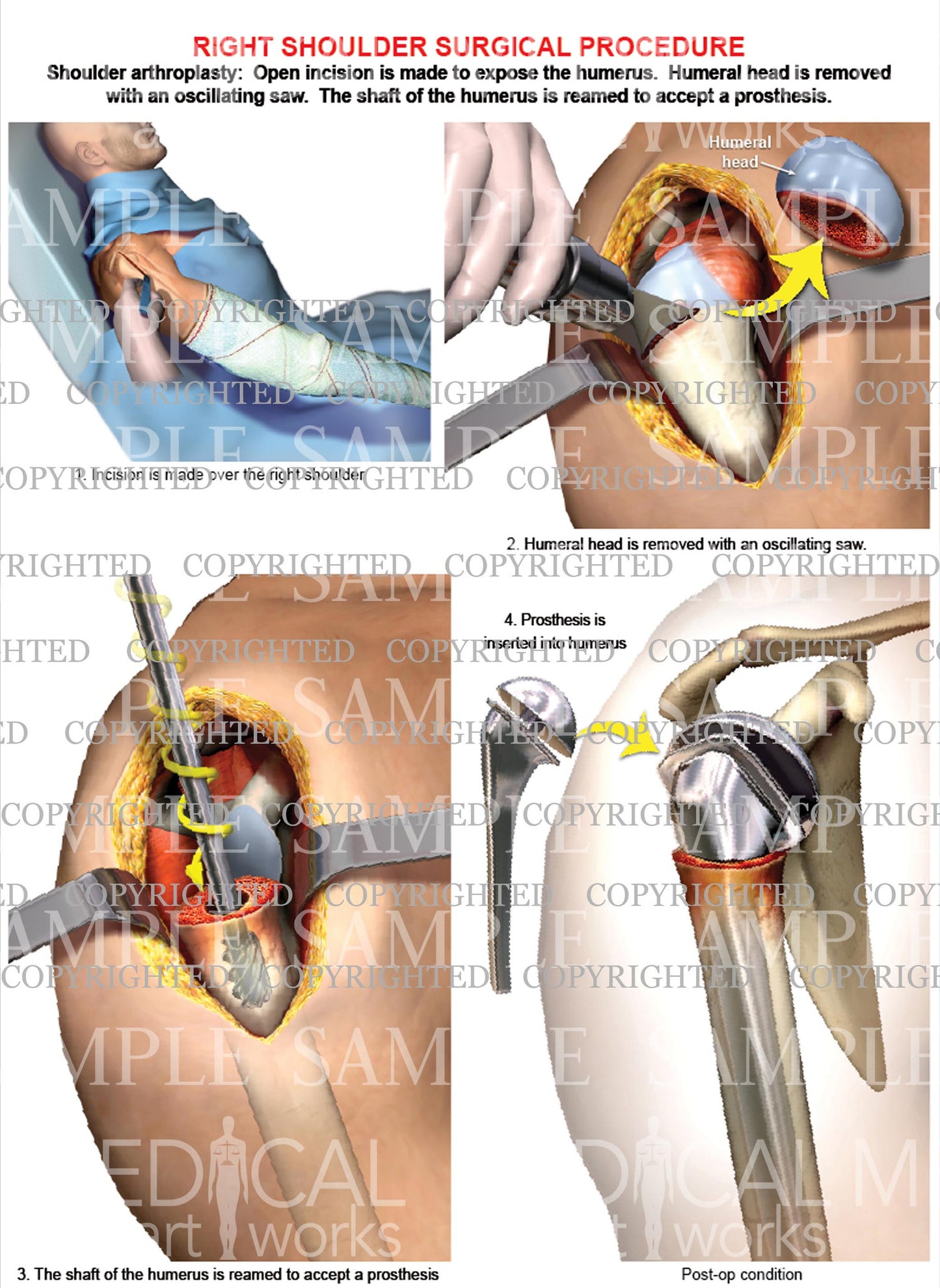 Right shoulder - Arthroplasty, Shoulder replacement