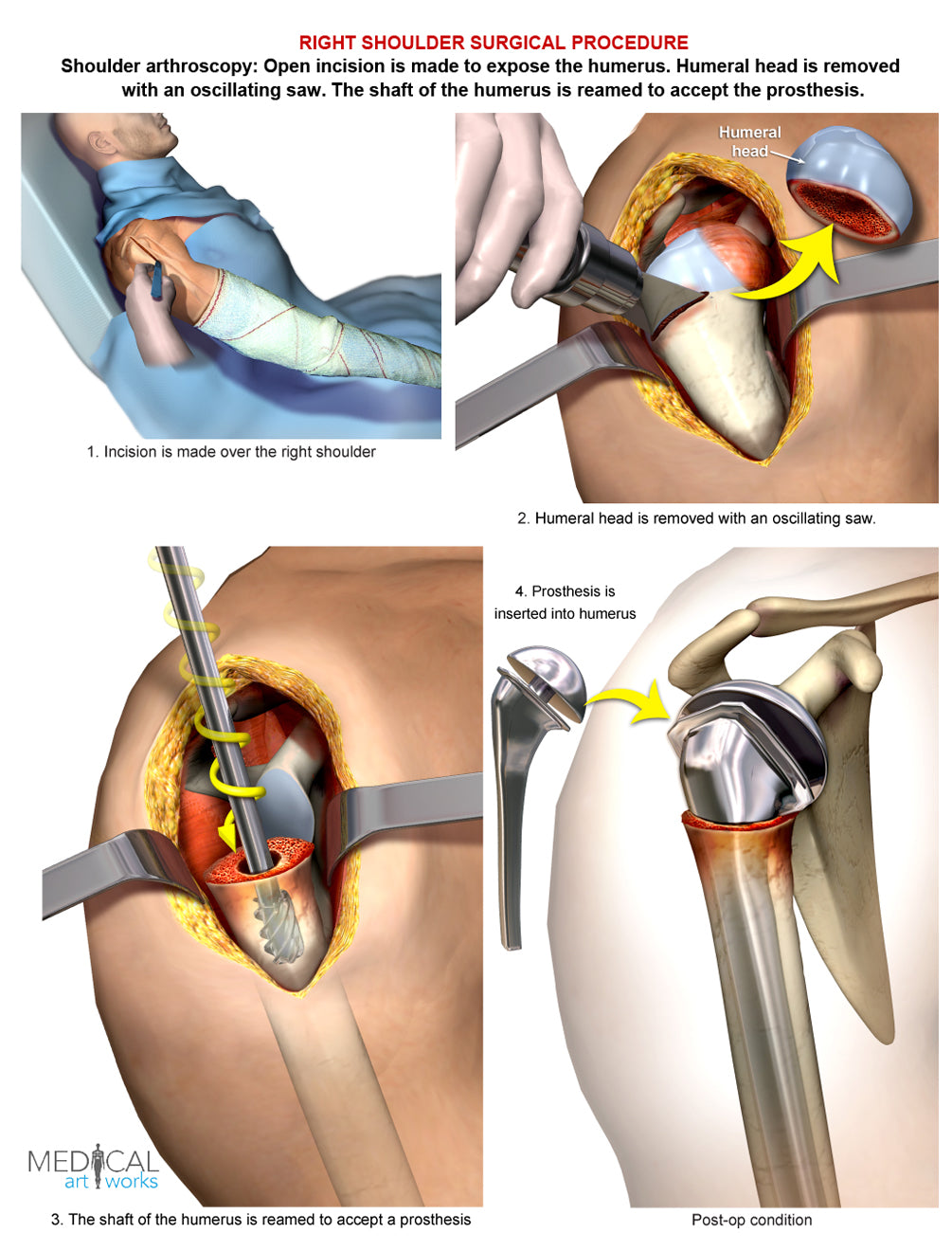 Right shoulder - Arthroplasty, Shoulder replacement