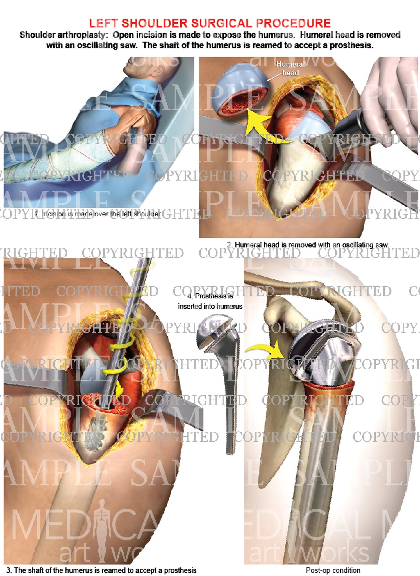 Left shoulder - Arthroplasty, Shoulder replacement