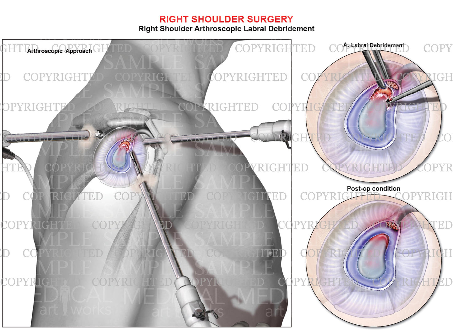 Right shoulder arthroscopic labral debridement