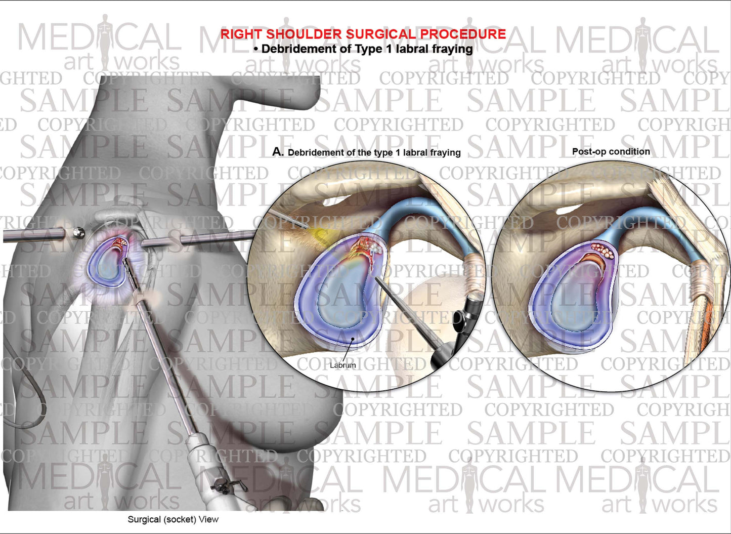 Right shoulder arthroscopic Surgery - Debridement type 1 labral fraying