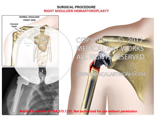 Right shoulder hemiarthroplasty