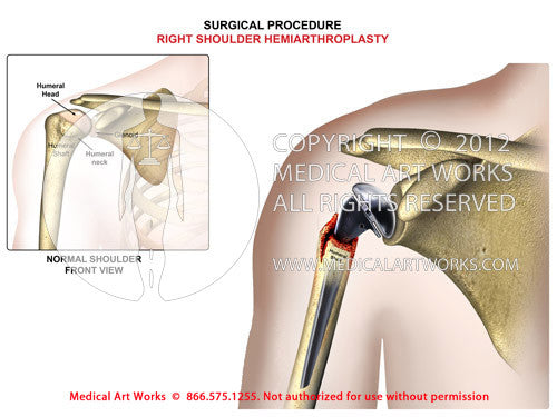 Right shoulder hemiarthroplasty