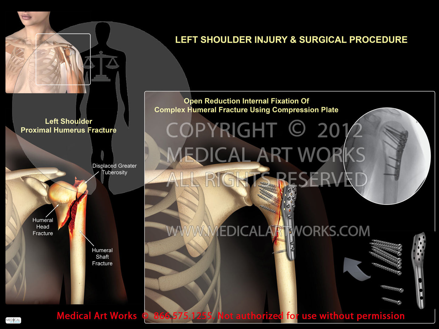 Left shoulder proximal humeral fracture+compression plate