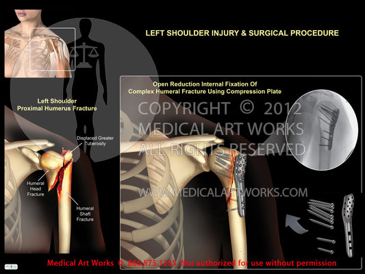 Left shoulder proximal humeral fracture+compression plate