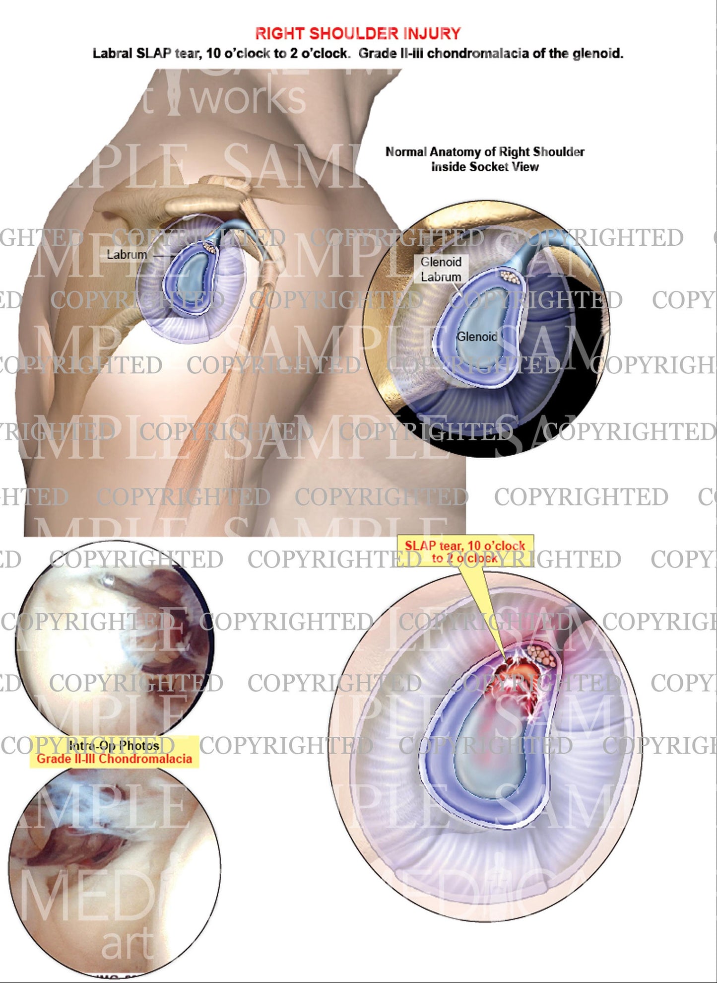 Labral SLAP tear - Glenoid chondromalacia grade 2-3 - Intra-op photos