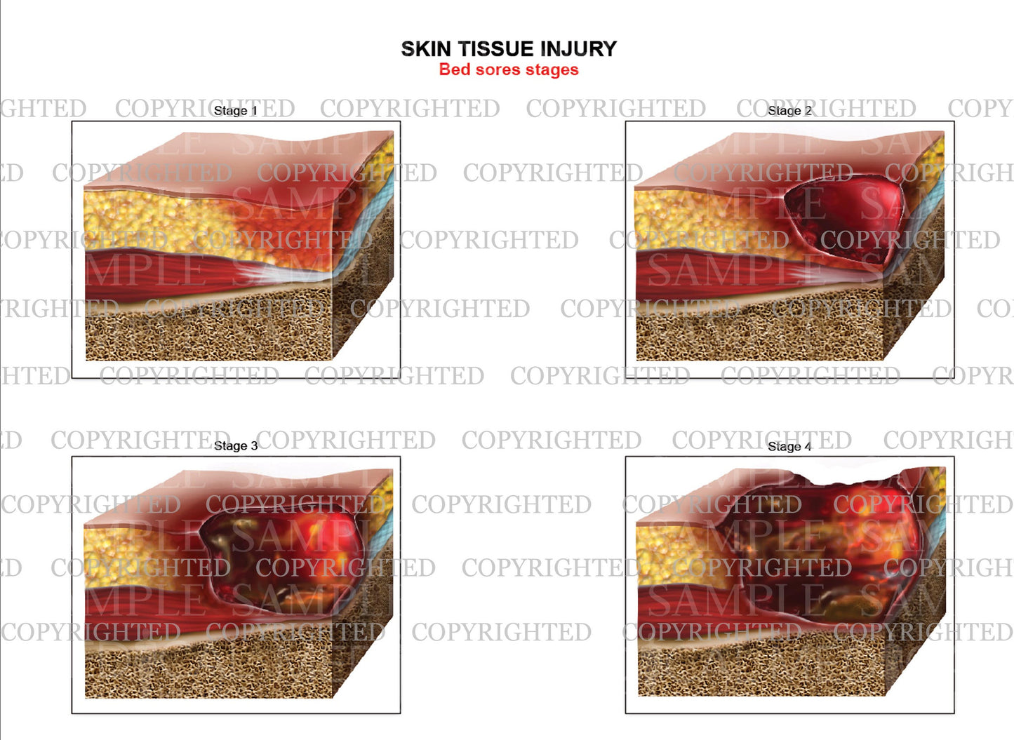 Bed sores classification chart