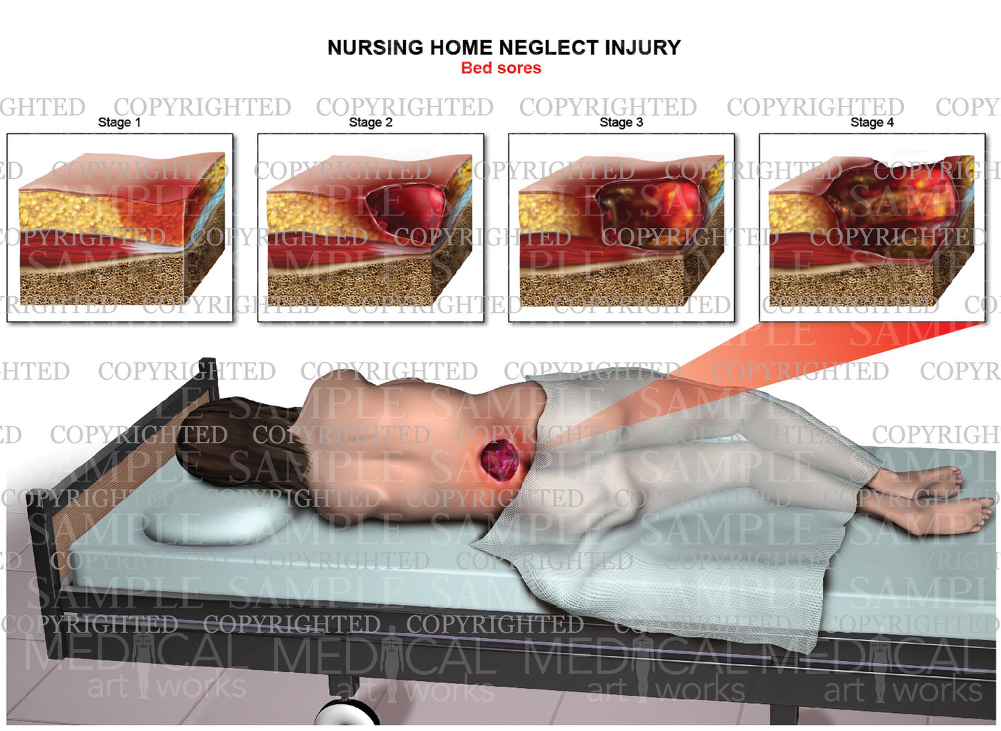 Nursing home neglect injury - Bed sores stages