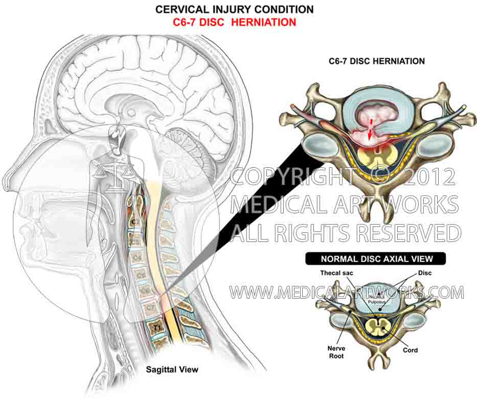 C6-7 disc herniation