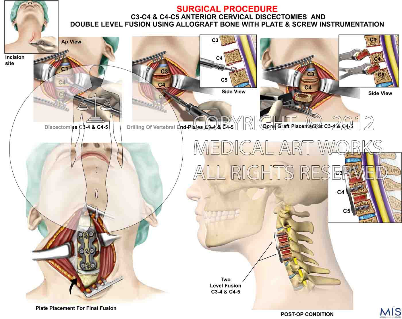 2 level - C3-4 and C4-5 discectomy and fusion. ACDF