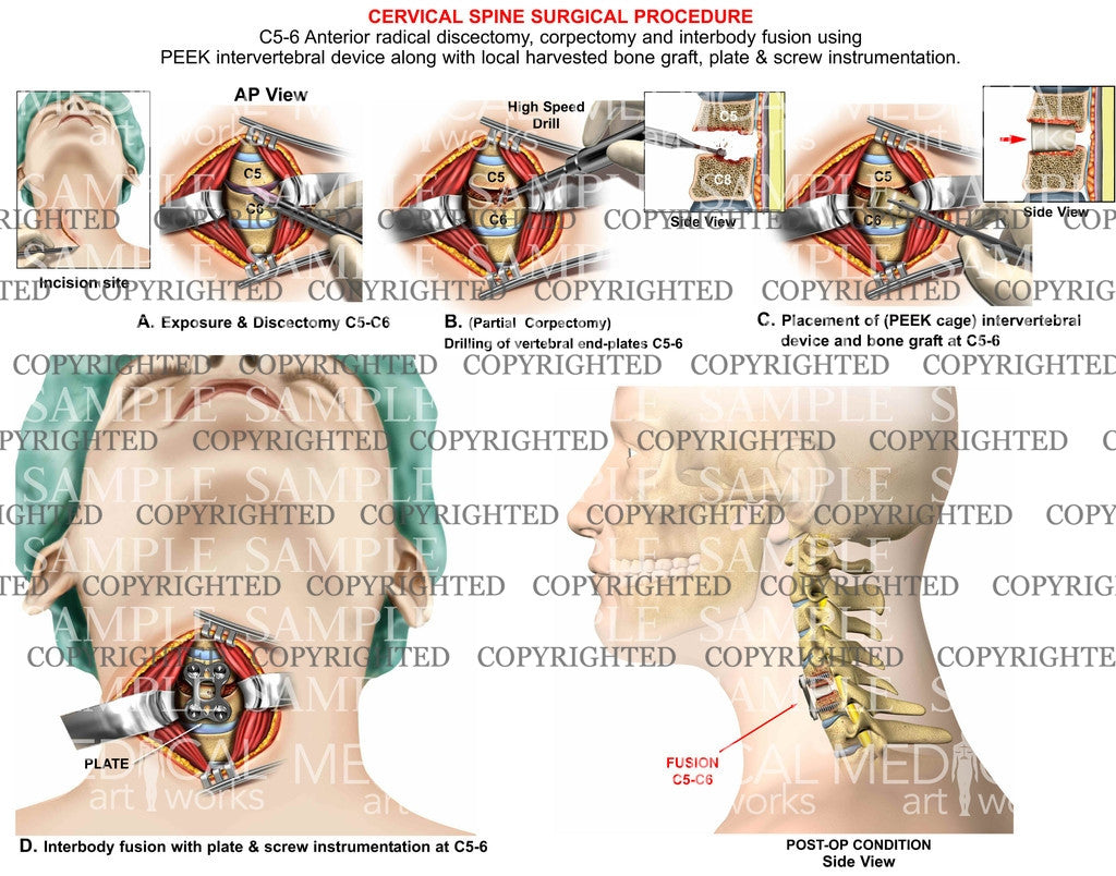 C5-6 anterior radical discectomy