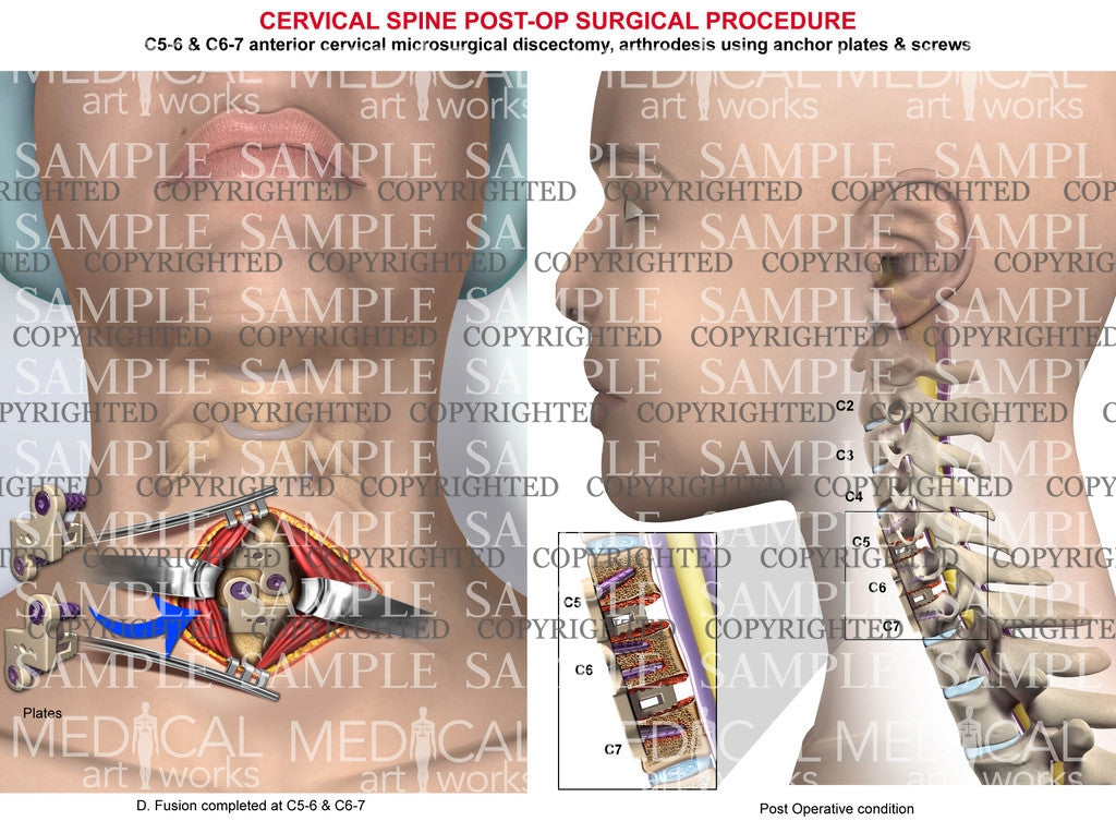 C5-6 & C6-7 Post operative fusion