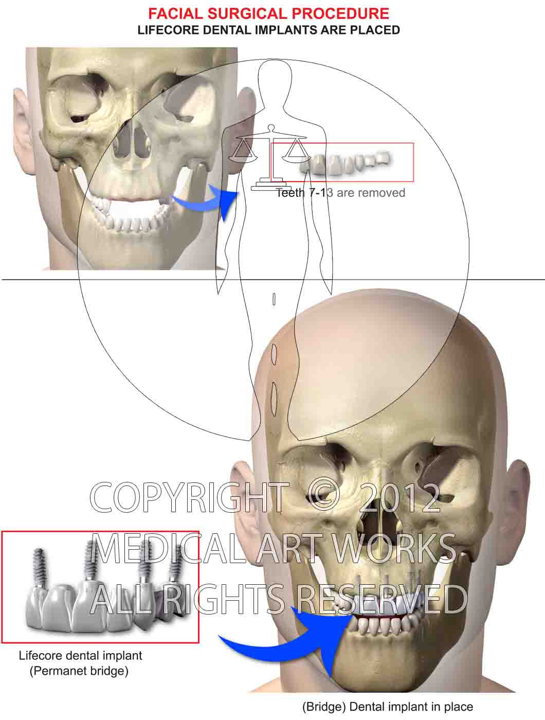 Oral maxilla-facial surgery with lifecore implants