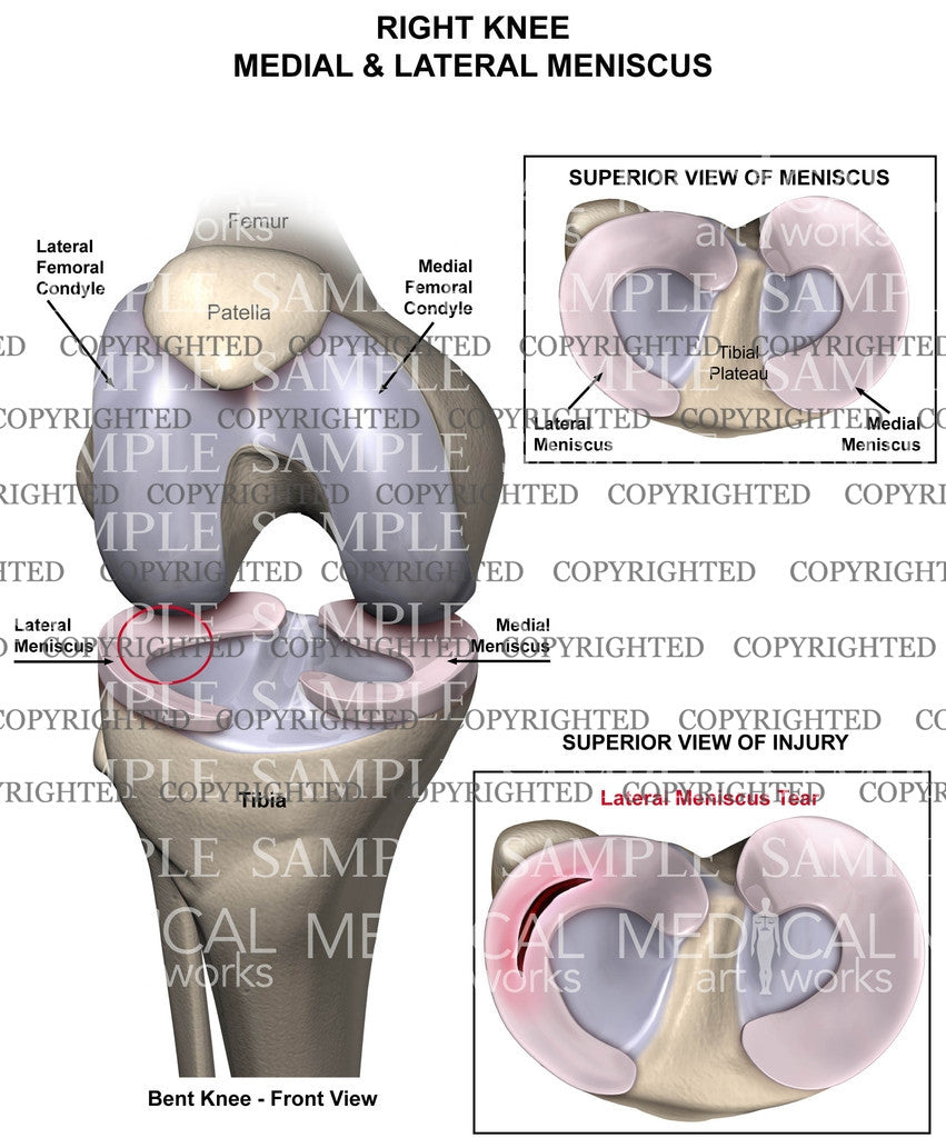 Knee meniscus tear