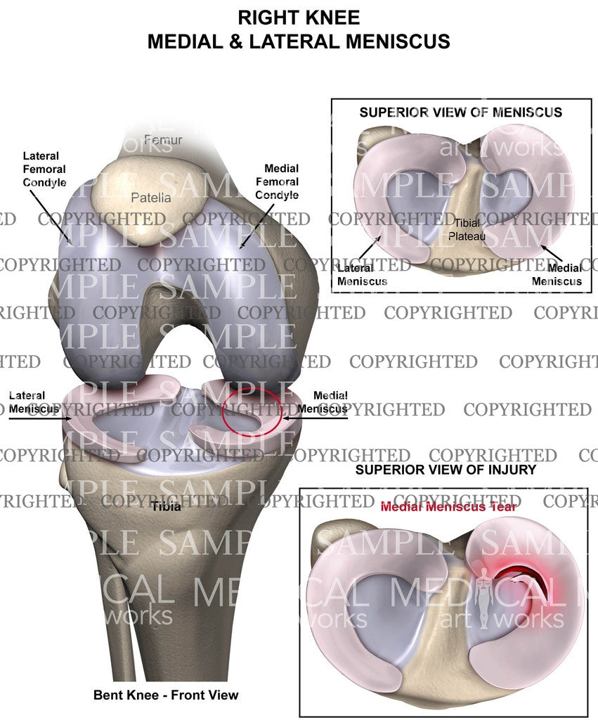 Medial meniscus tear of right knee