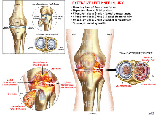 Extensive Left Knee injury