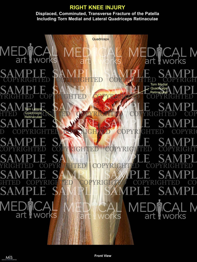 Displaced, Comminuted, Transverse Fracture of the Patella