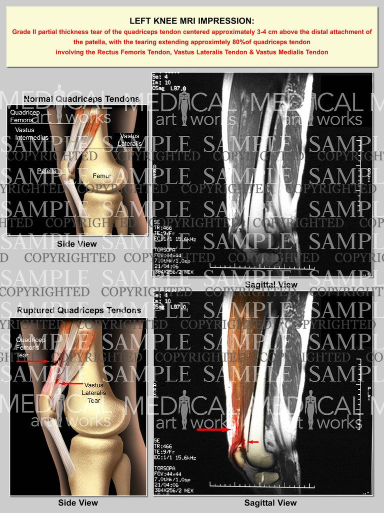 Grade 2 partial thickness tear of the left quadriceps tendon