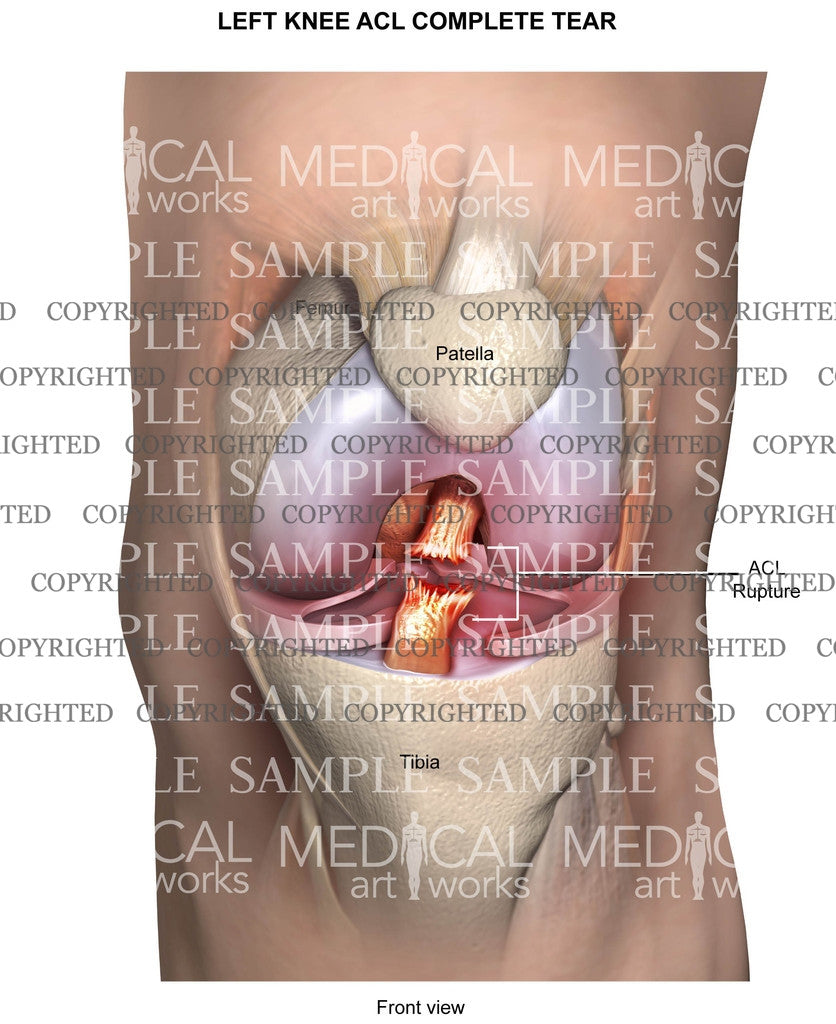 Left knee ACL complete tear