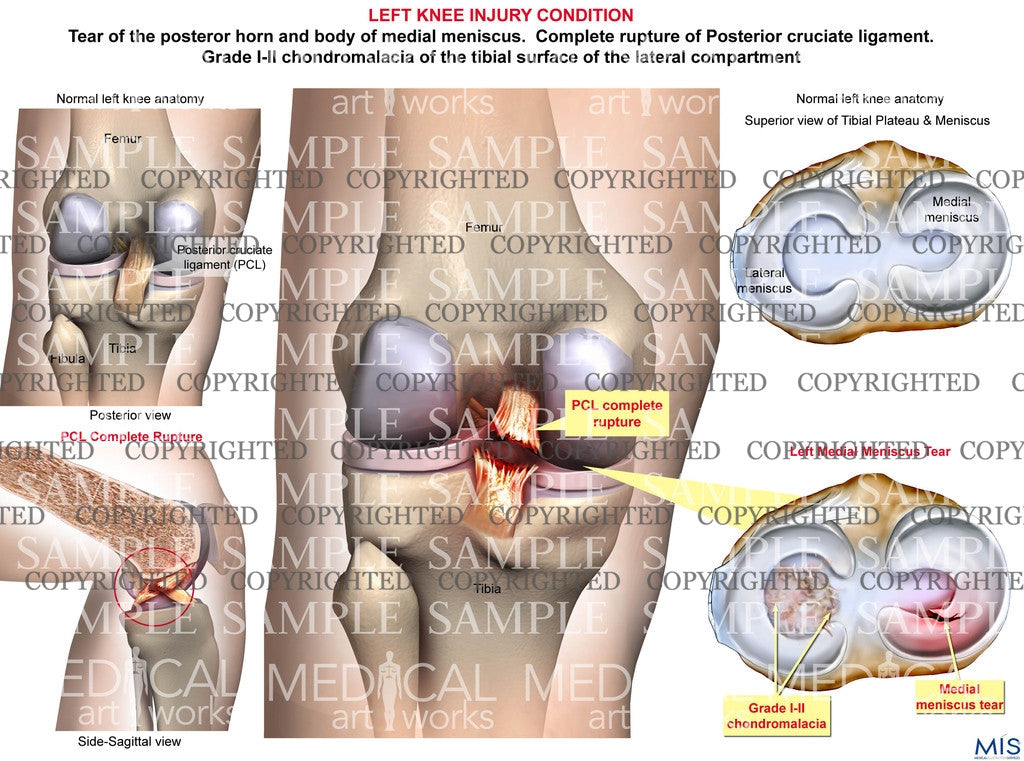 Left Knee Posterior Injury