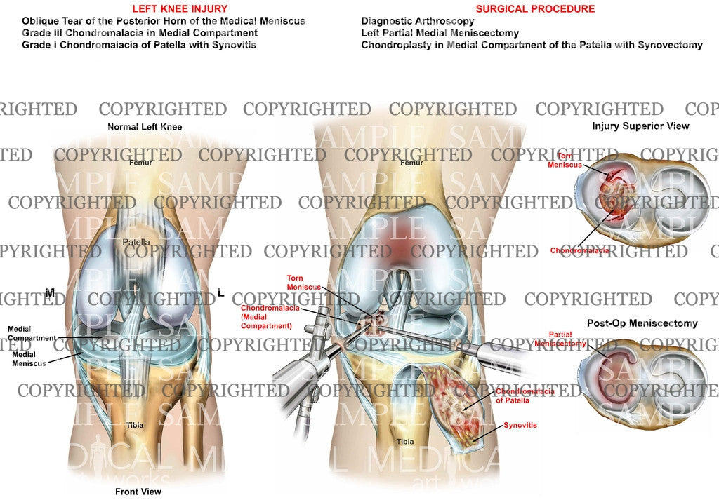 Left knee meniscal injury, synovitis, chondromalacia & arthroscopic surgery