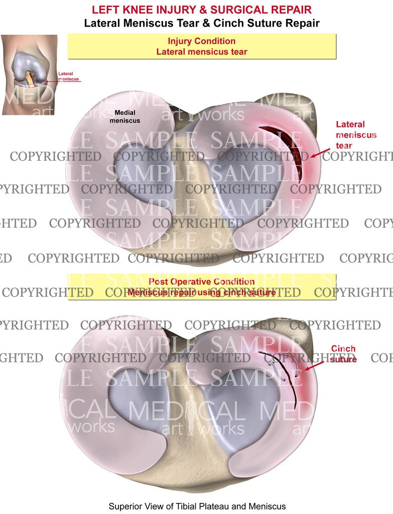 Left knee cinch suture