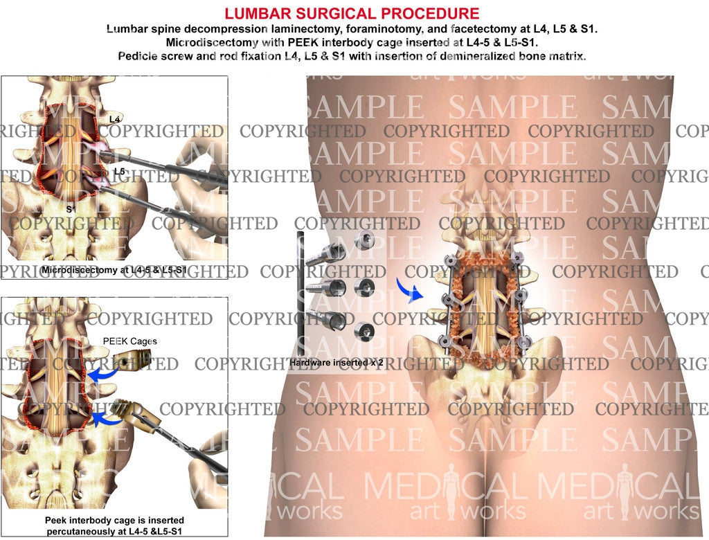 2 level - L4, L5, S1 Fusion, instrumentation, interbody graft
