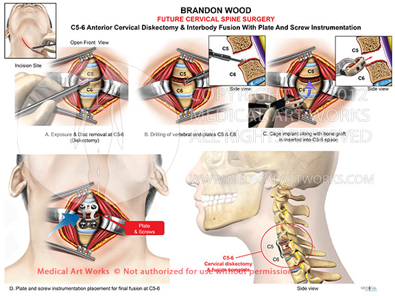 1 level - C5-6 Anterior cervical discectomy and fusion ACDF