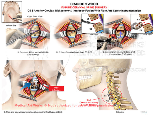 1 level - C5-6 Anterior cervical discectomy and fusion ACDF