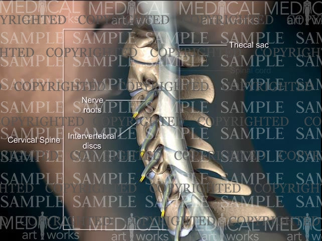 Cervical spine broad based central disc herniation - Male
