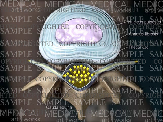 Lumbar spine broad based central disc herniation - Female