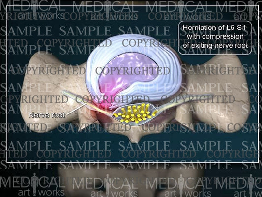 Lumbar spine paracentral disc herniation - Male