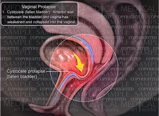 Vaginal Prolapse - Cystocele (fallen bladder)