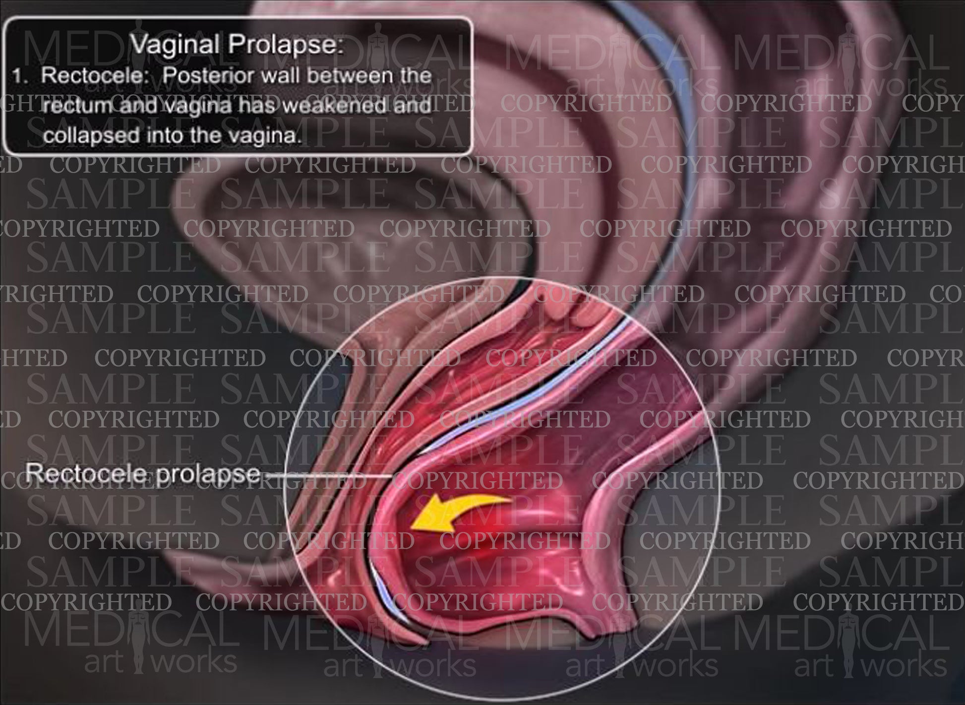 Vaginal prolapse, Rectocele collapse
