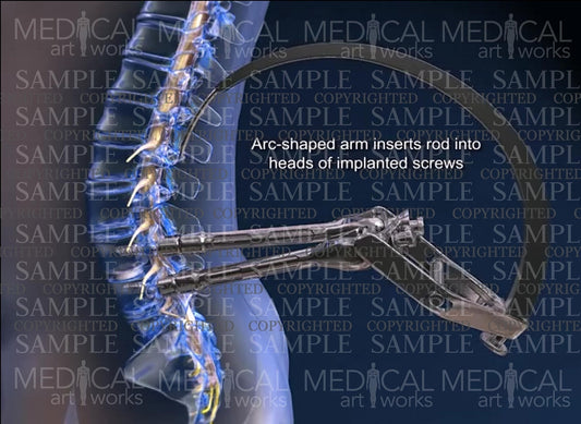 Medtronics sextant fixation system of L4-5 spine