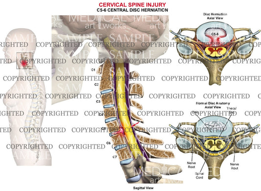 C5-6 disc herniation - central