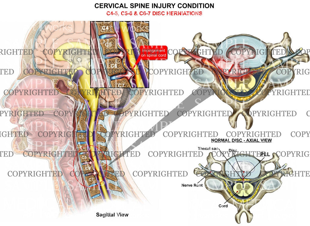 three level cervical disc herniation