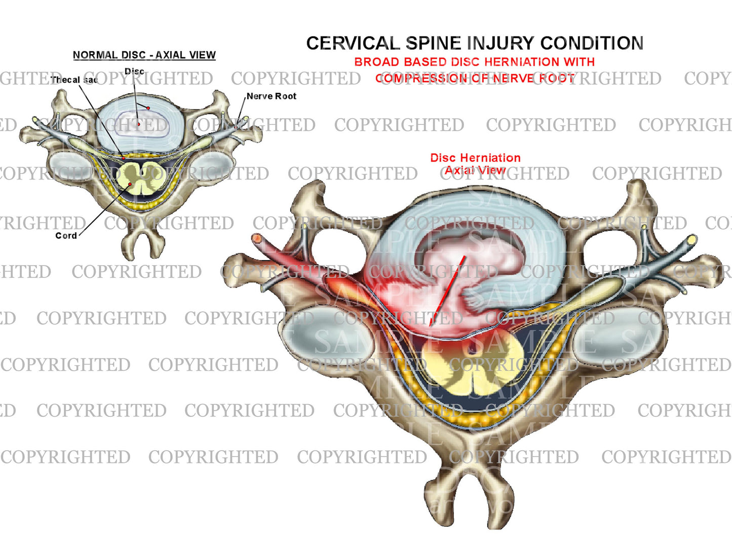 Cervical disc herniation + compression - axial view