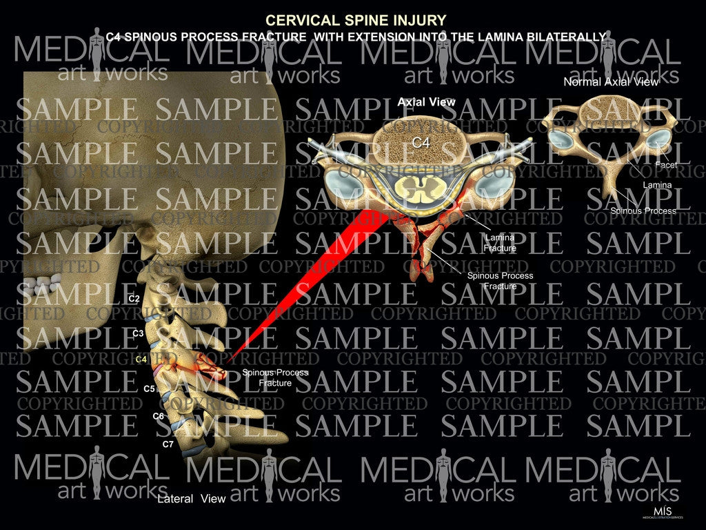 C4 cervical spinous process fracture