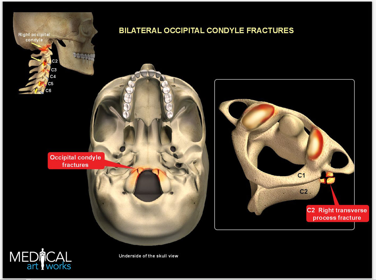 Condyle Pain Skull occipital condyle fracture – Medical Art Works