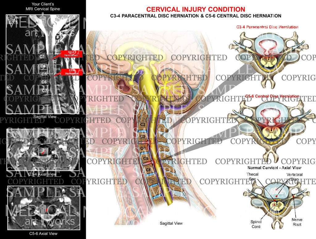 two  level disc herniations