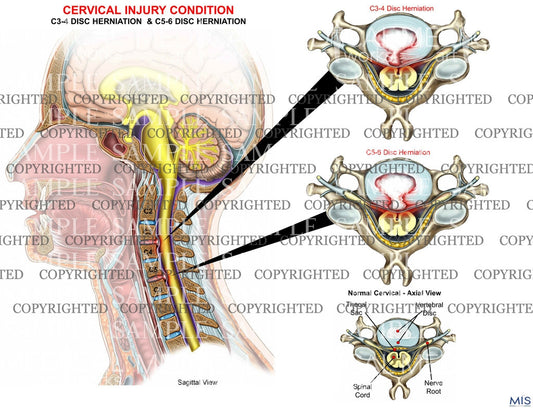 2 level - C3-4 and C5-6 cervical spine central disc herniations